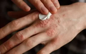 Día Mundial de la Psoriasis: Por qué se recuerda y cómo prevenir la enfermedad