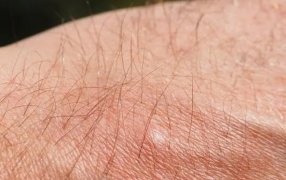 En el marco del Día Internacional: Lanzan una App gratuita para ayudar a las personas con urticaria crónica