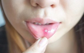 Llagas en la boca: Por qué salen y remedios caseros para combatirlas