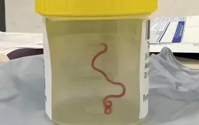 Nunca antes visto: Una mujer fue operada del cerebro y los médicos encontraron algo increíble