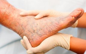 Argentina, "alta carga" de Lepra con cerca de 150 casos nuevos por año