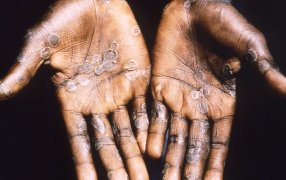 Un hombre de 44 años: Confirmaron la primera muerte por MPOX (viruela símica) en la Argentina, en el país ya se registraron 895 casos