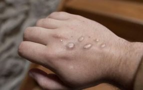 Alarma mundial de la OMS: Viruela del mono en Argentina, reportaron ocho casos, cuatro de ellos por antecedentes de viajes y aumenta la preocupación