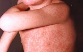 Alerta por sarampión: El mapa del recorrido que hizo la familia infectada a bordo de tres ómnibus de larga distancia