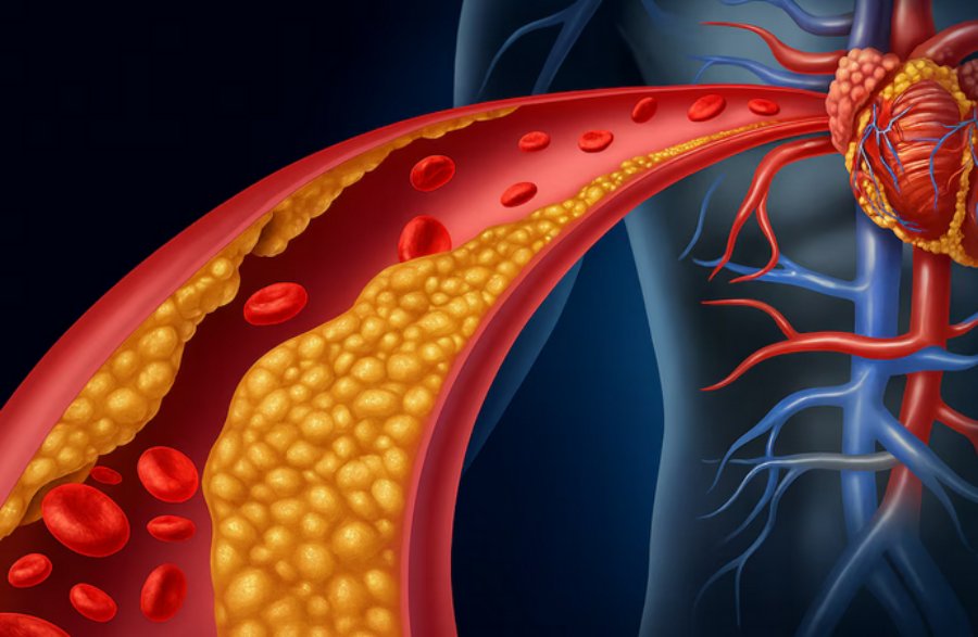 Uno de cada tres argentinos tiene niveles elevados de un tipo de colesterol genético