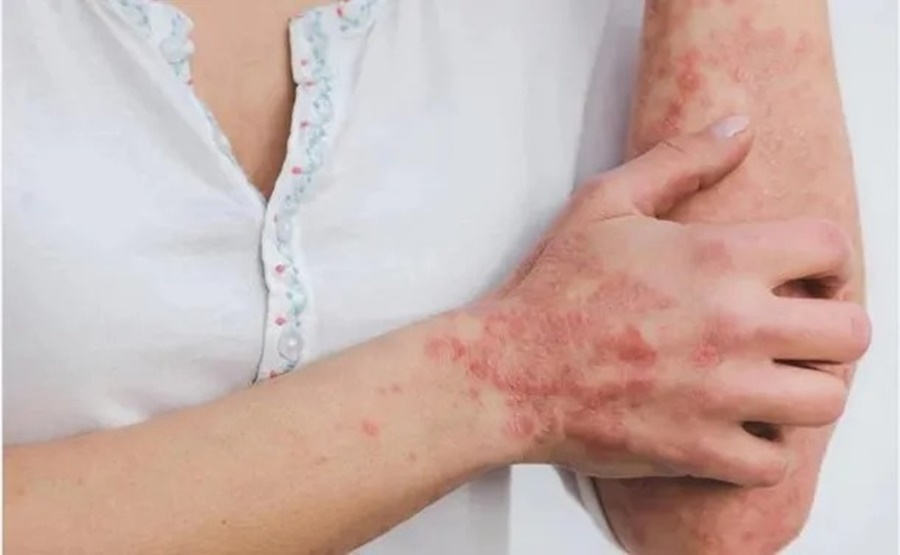 El fin de la viruela del mono: La OMS dio por terminada la emergencia sanitaria global