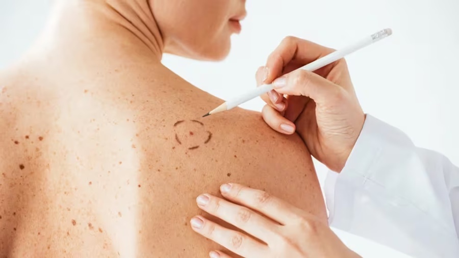 Cinco consejos para cuidarse la piel en verano